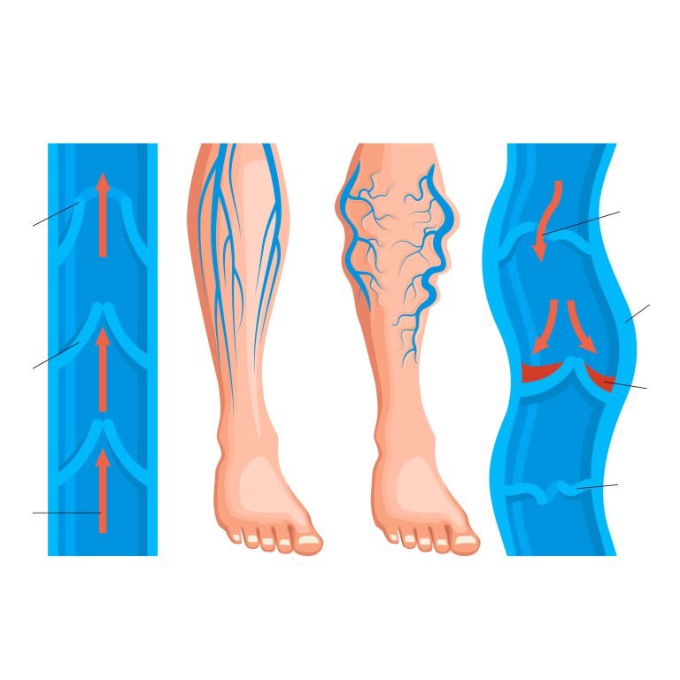 Venous disease of legs infographics scheme of blood flow in healthy and varicose veins realistic vector illustration