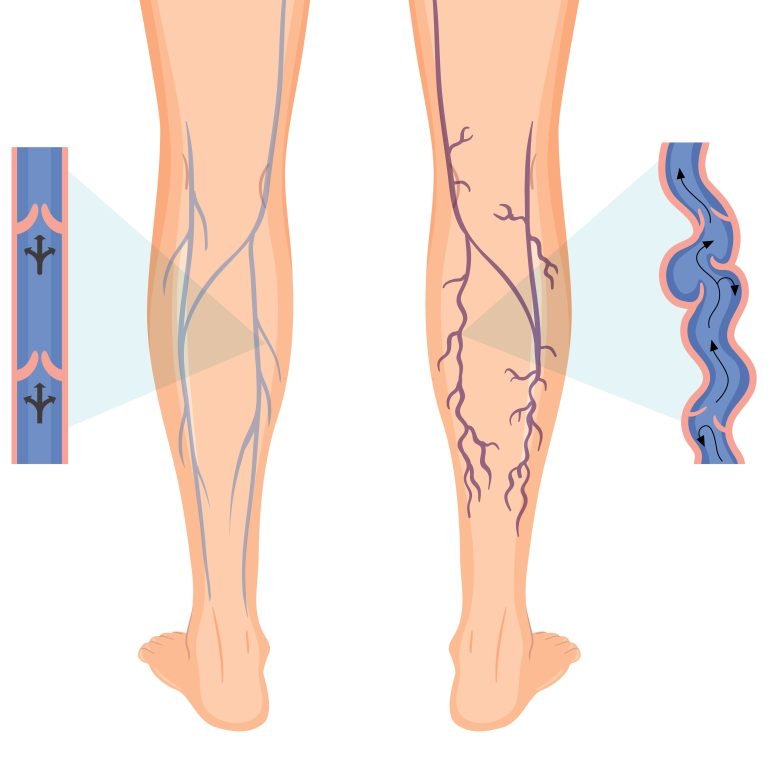 Human legs with varicose vein illustration